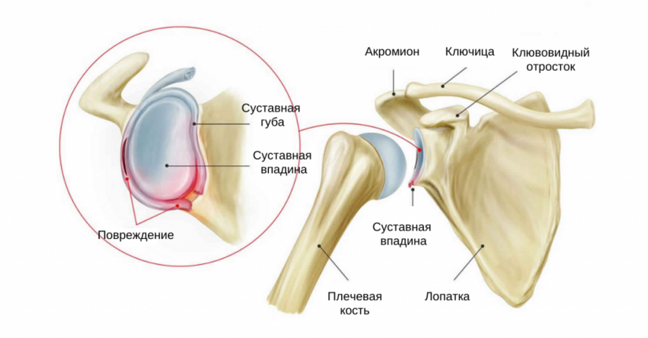 Анатомическая схема суставной губы и повреждения Банкарта