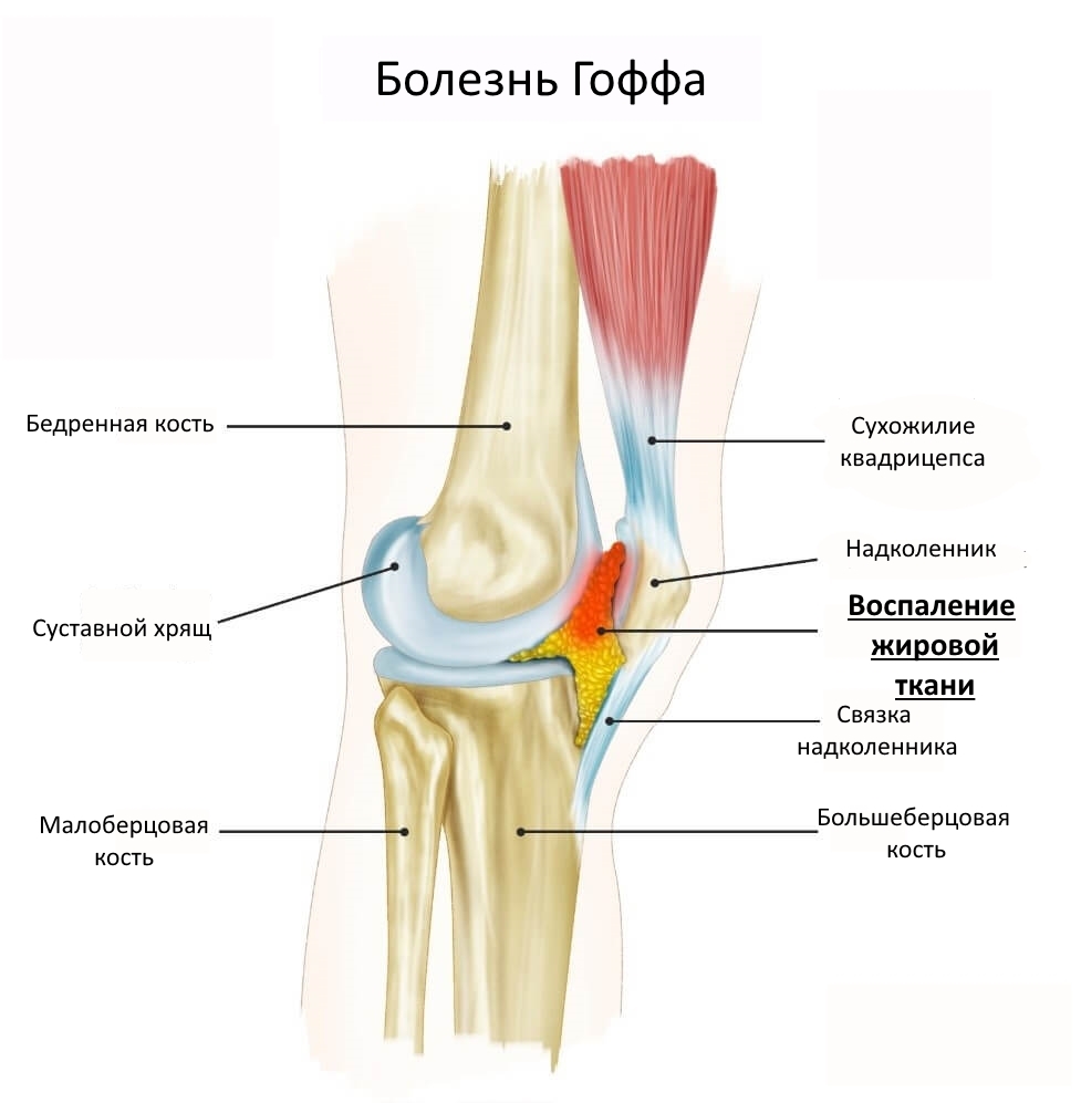 Схема воспаления жирового тела Гоффа под надколенником