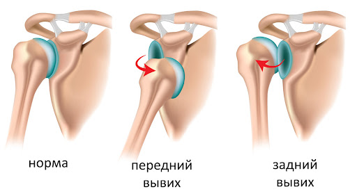 Схема нормального плечевого сустава, переднего и заднего вывиха